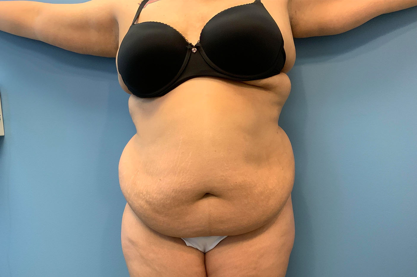 before tummy tuck front view of female patient case 4739