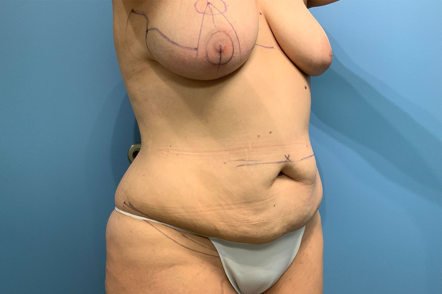 before tummy tuck right angle view of female patient case 4744