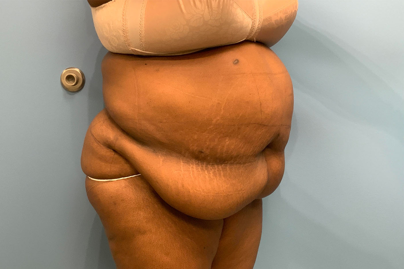 before tummy tuck right angle view of female patient case 4754