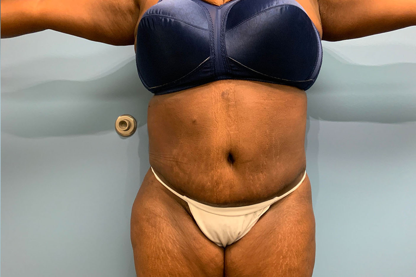 after tummy tuck front view of female patient case 4754