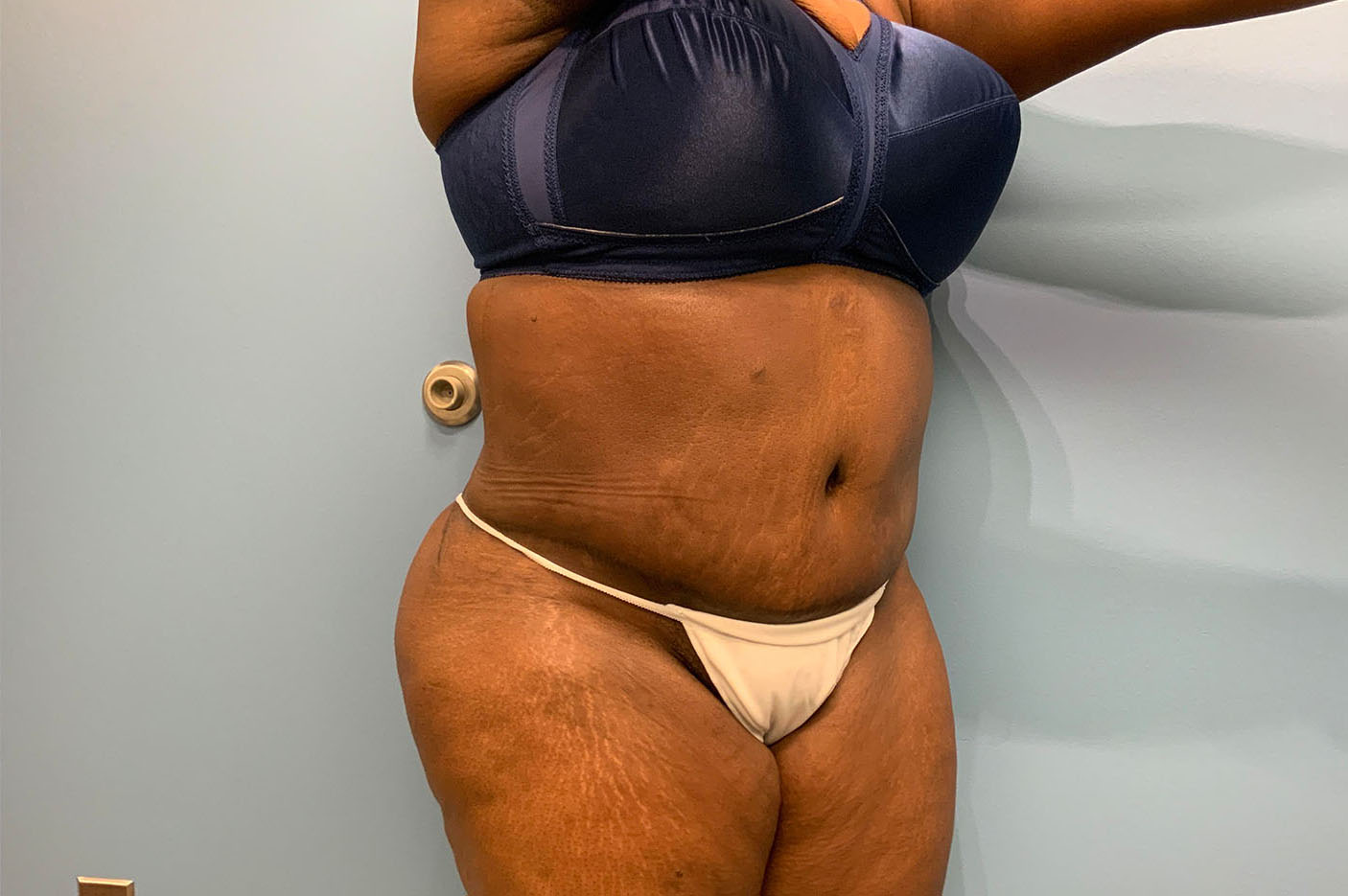 after tummy tuck right angle view of female patient case 4754