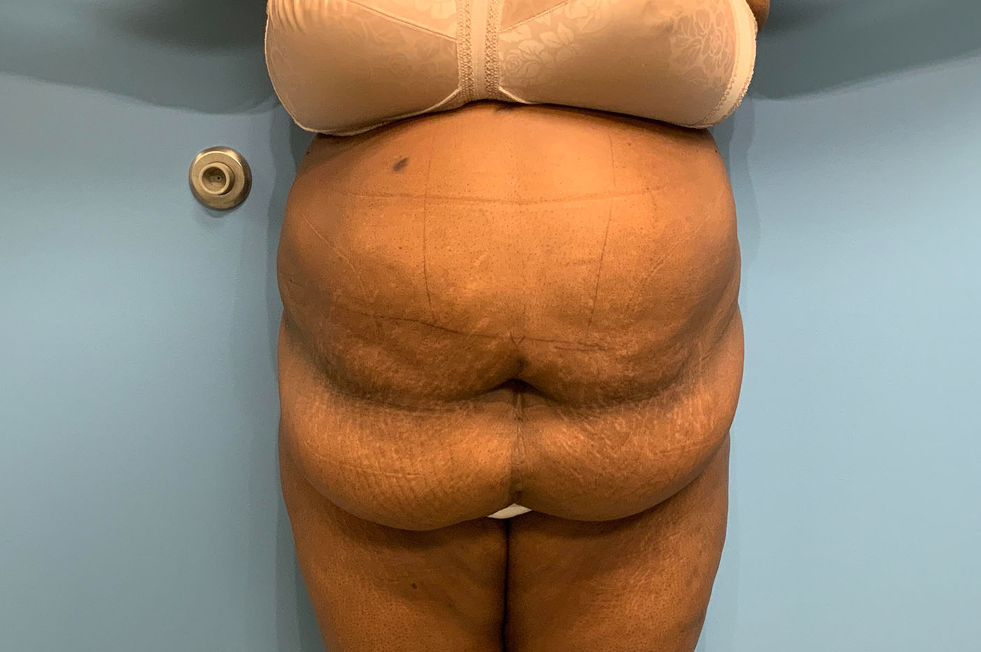 before tummy tuck front view of female patient case 4754