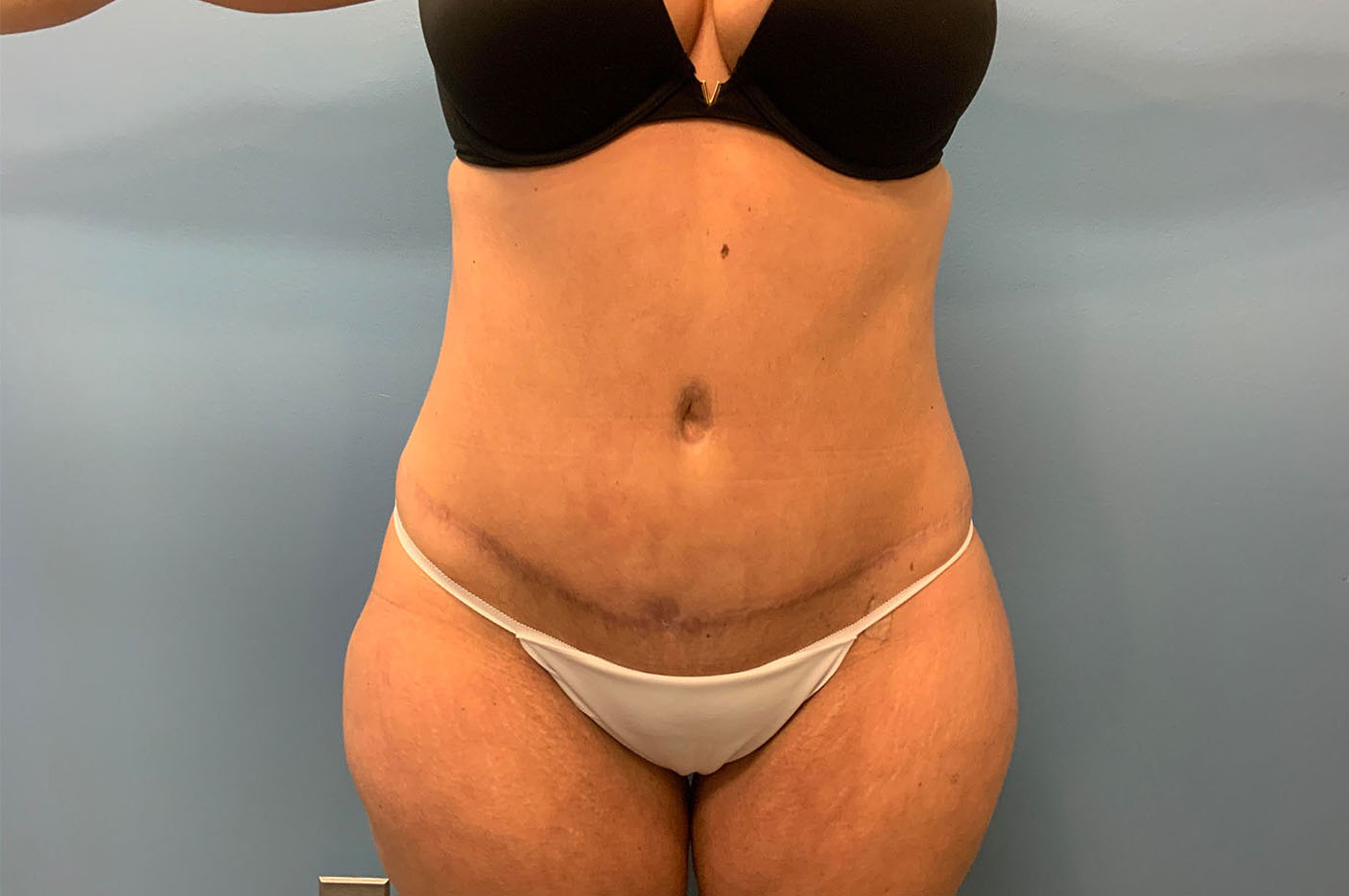 after tummy tuck front view of female patient case 4759