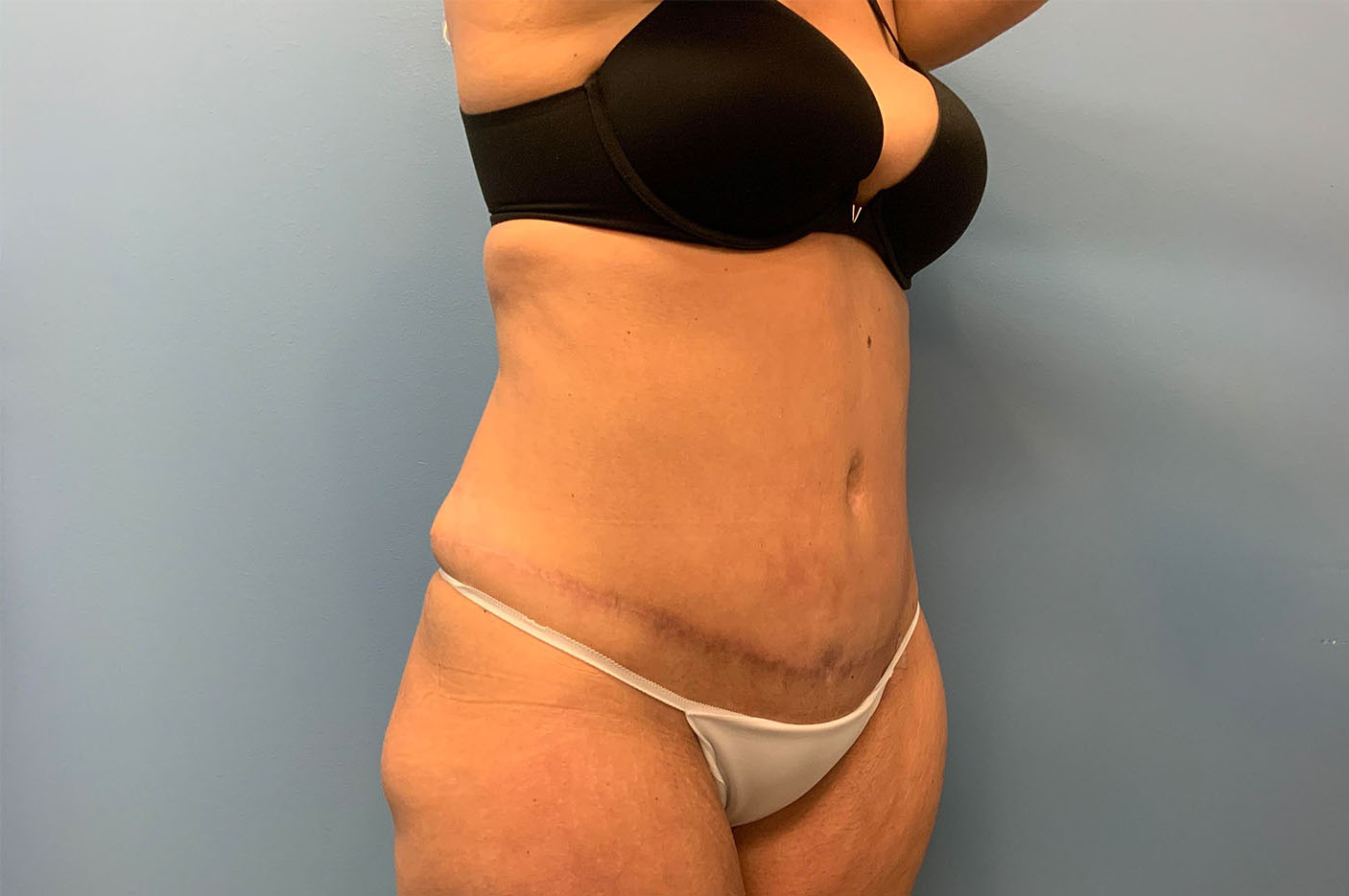 after tummy tuck right angle view of female patient case 4759