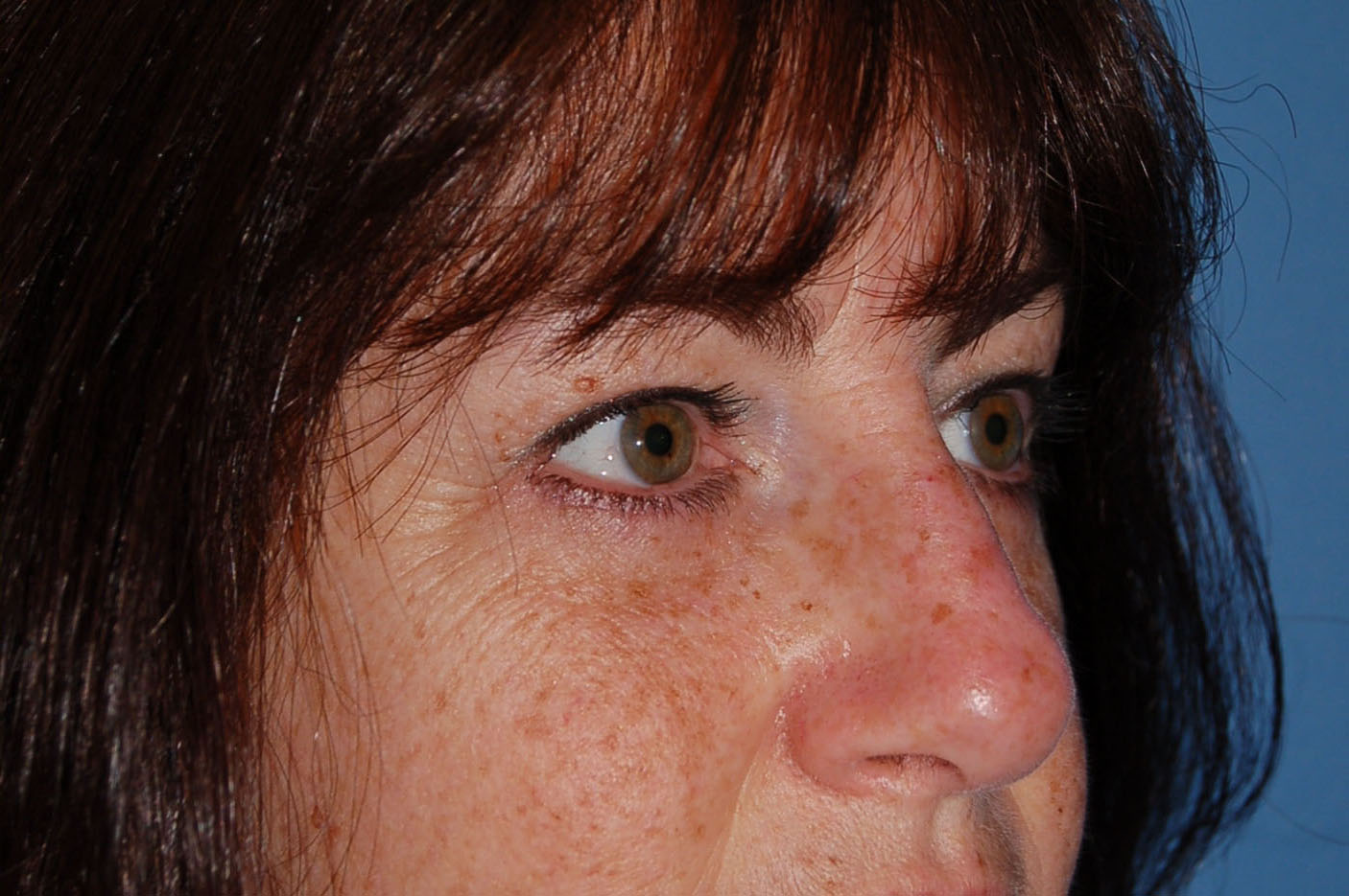 after blepharoplasty right angle view of female patient 5432