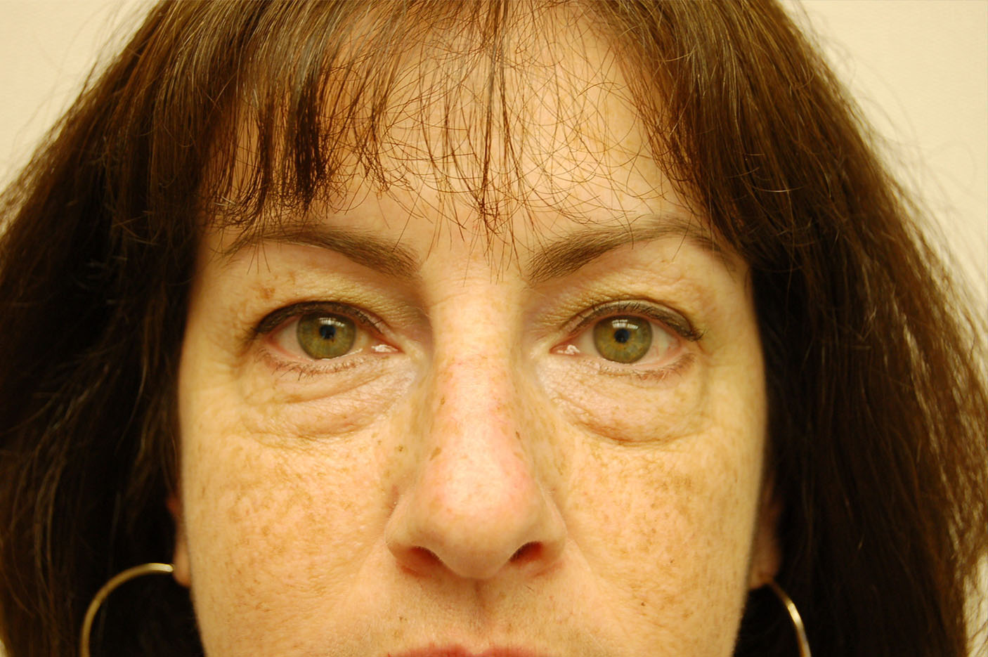 before blepharoplasty front view of female patient 5432
