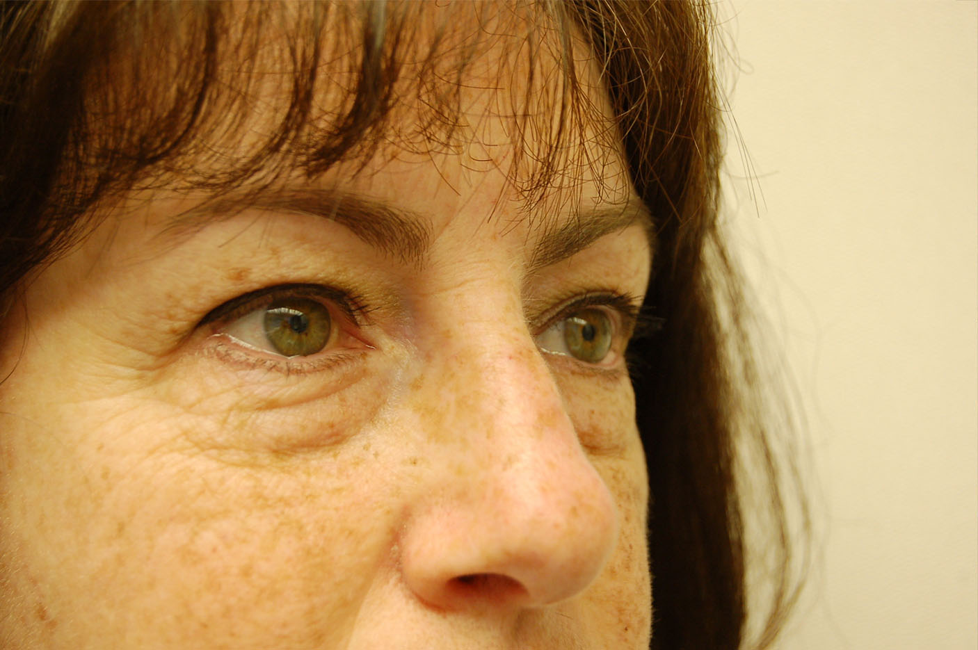 before blepharoplasty left angle view of female patient 5432