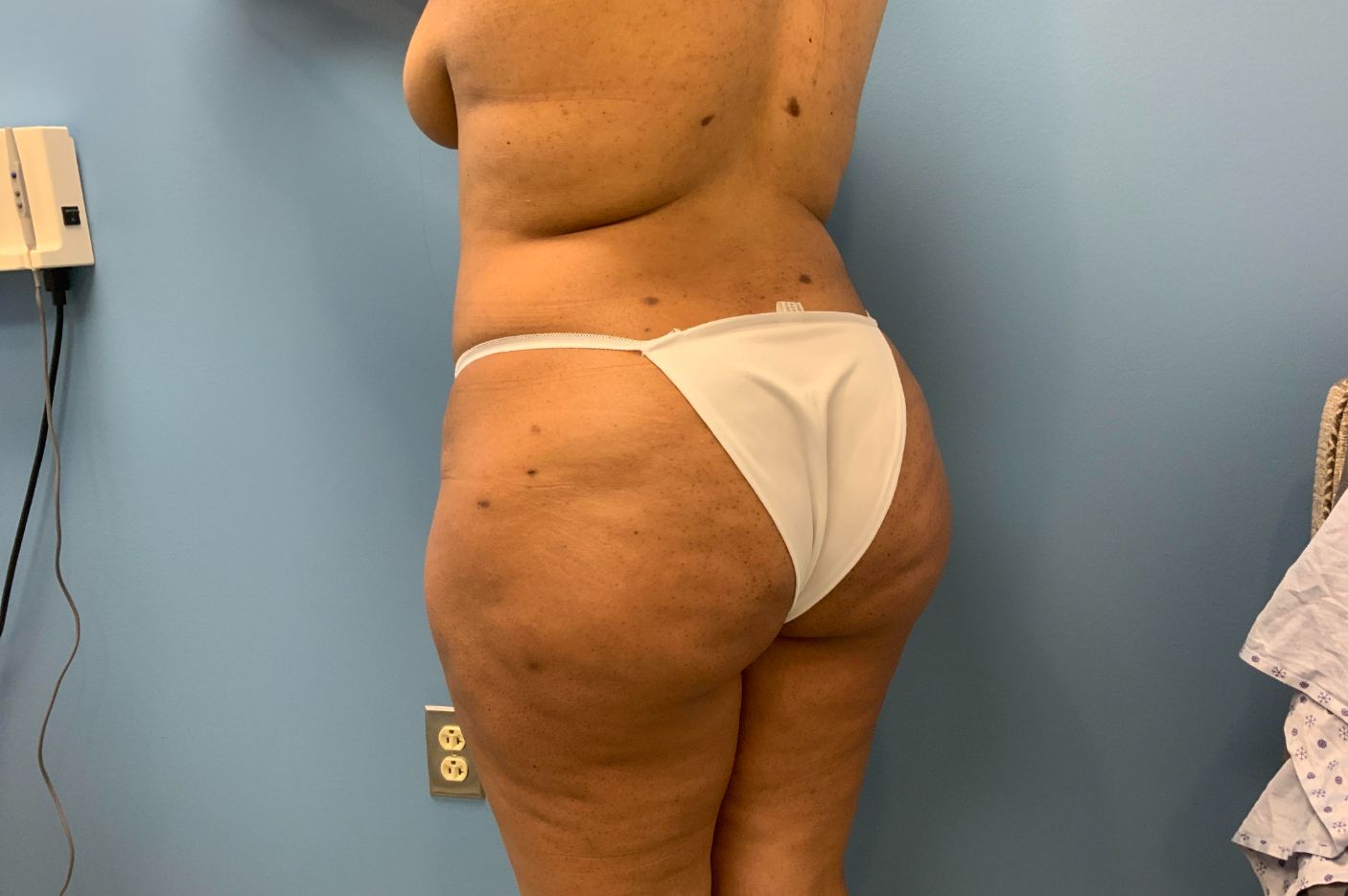after Brazilian butt lift left back angle view of female patient 5447