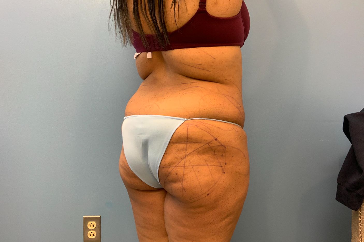 before Brazilian butt lift right back angle view of female patient 5447