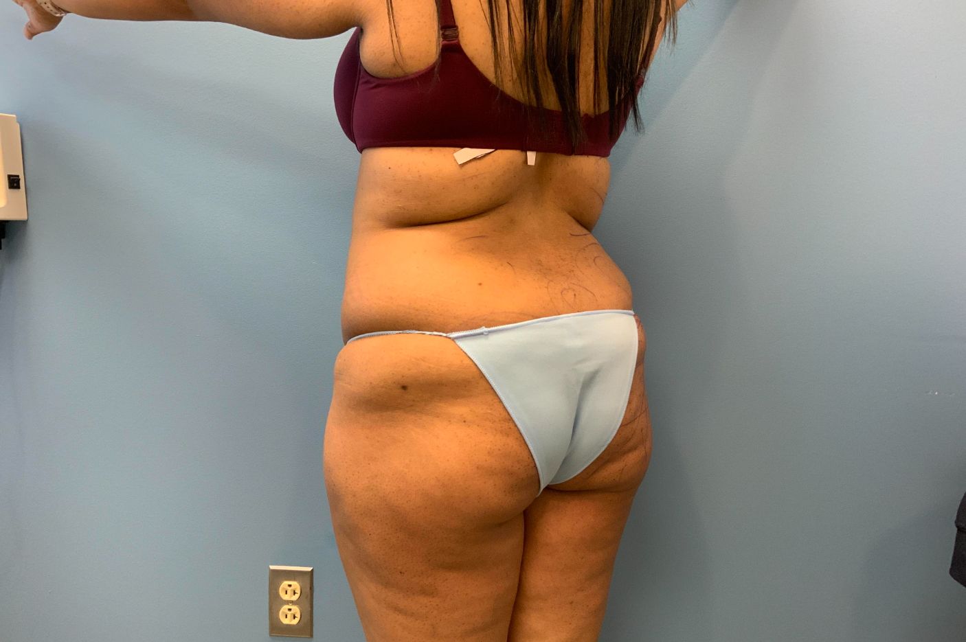 before Brazilian butt lift left back angle view of female patient 5447