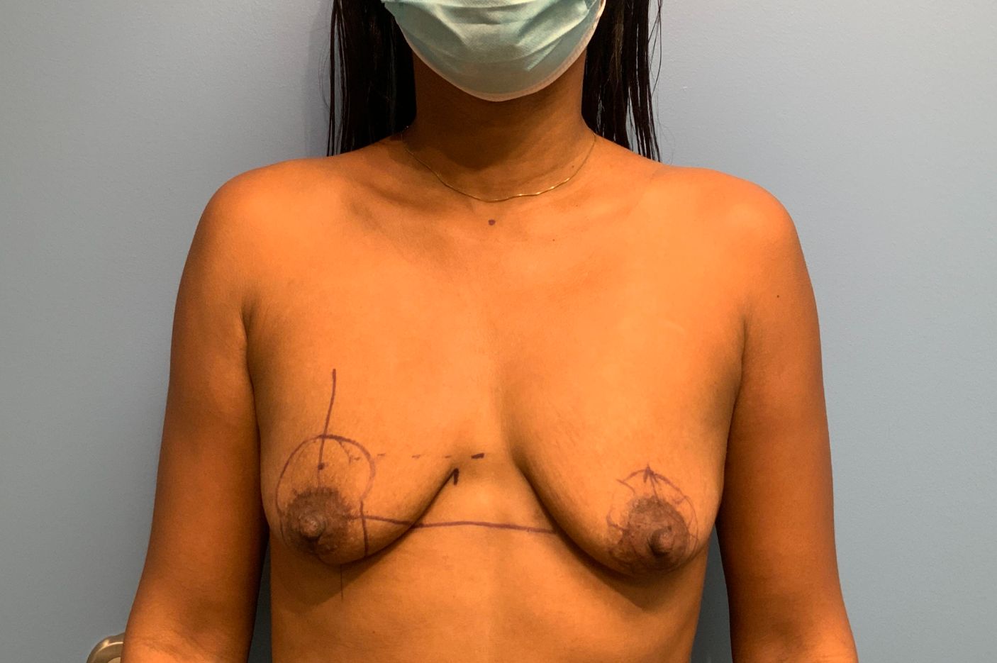 before breast augmentation with lift front view female patient case 5495