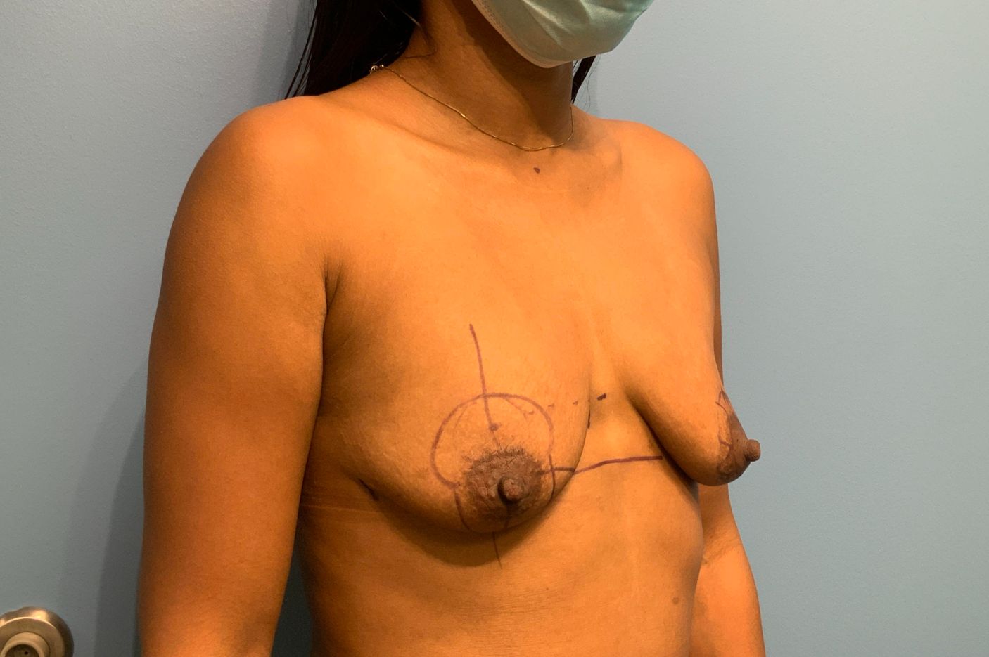 before breast augmentation with lift right angle view female patient case 5495