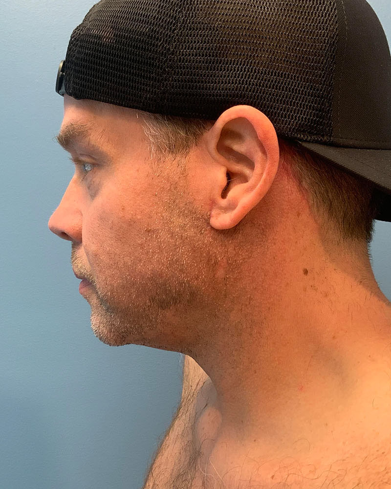 after neck lift left side view male patient case 5474