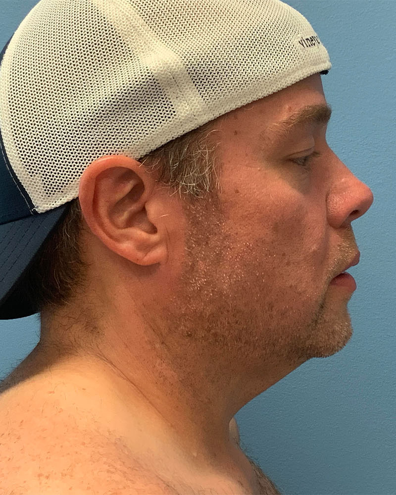 before neck lift right side view male patient case 5474