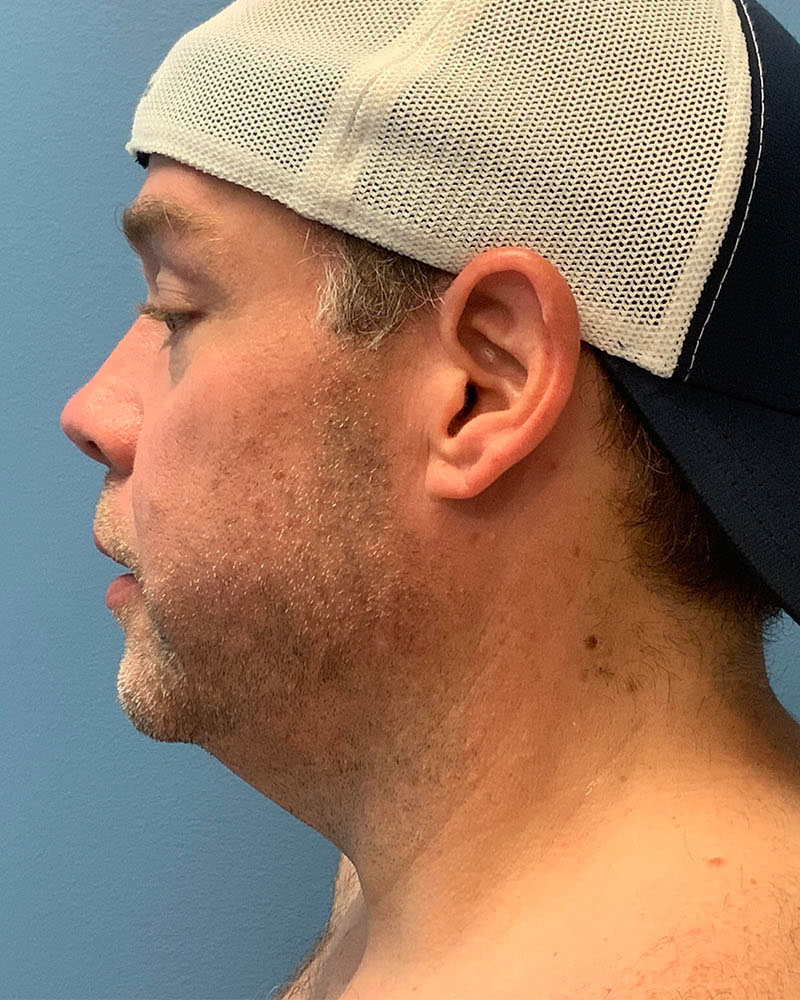 before neck lift left side view male patient case 5474