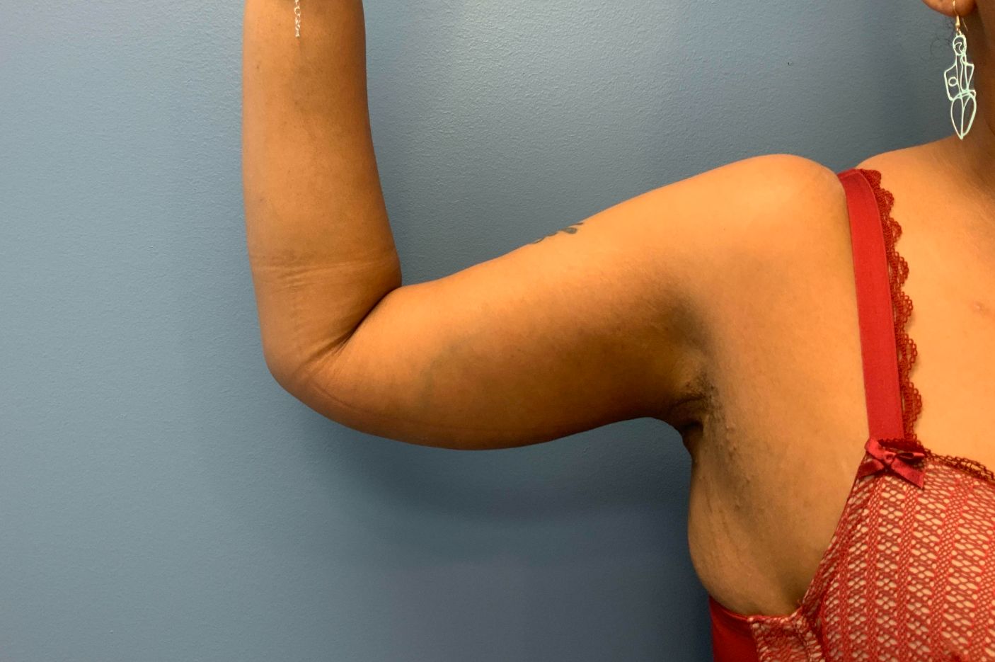 after surgery after weight loss right arm view female patient case 5488