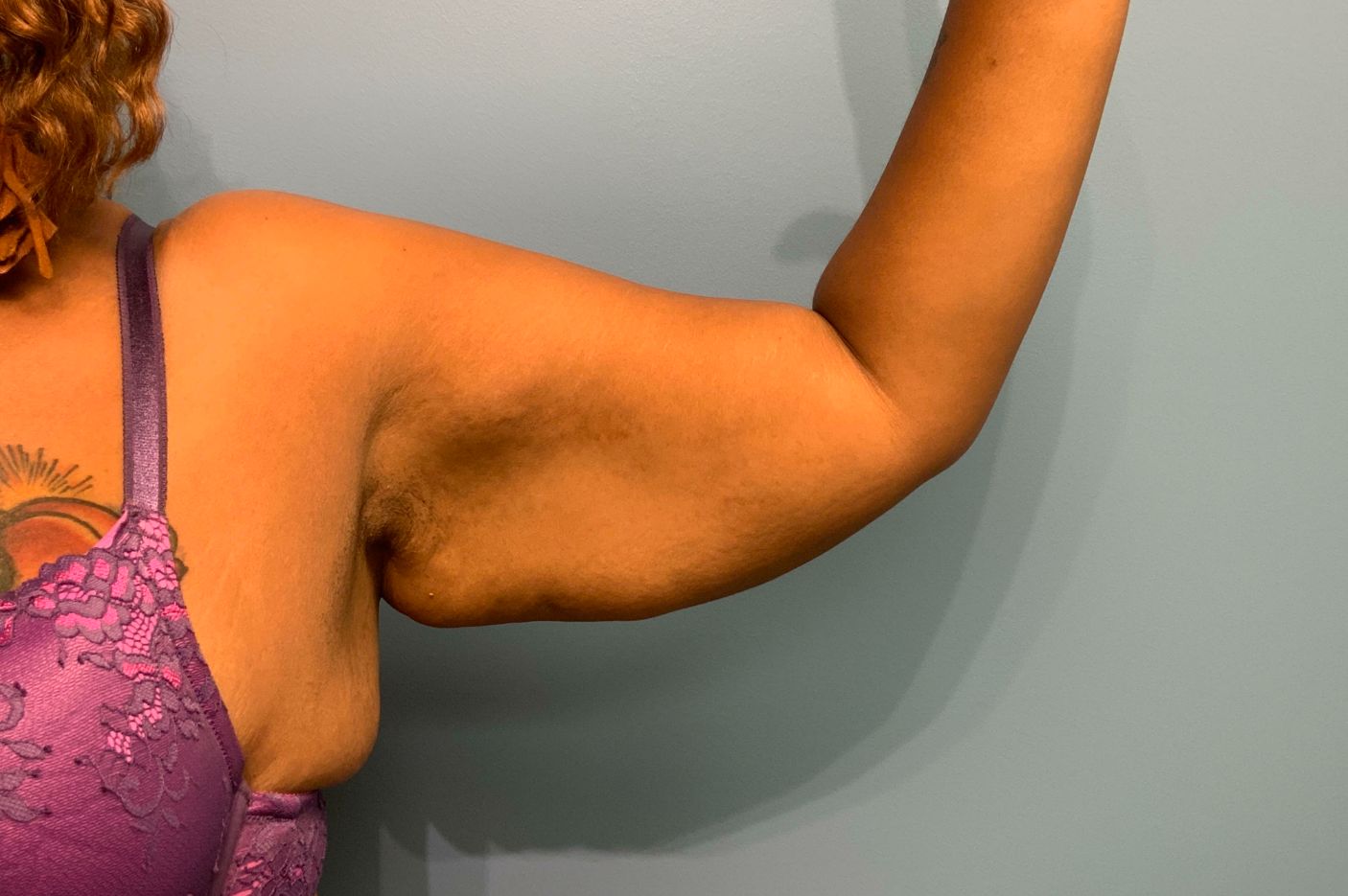 before surgery after weight loss left arm view female patient case 5488
