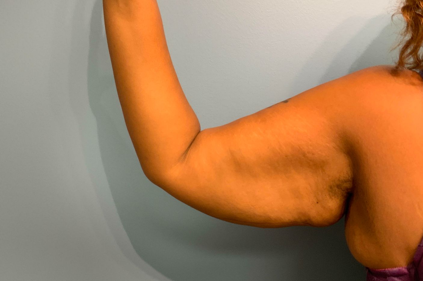 before surgery after weight loss right arm view female patient case 5488