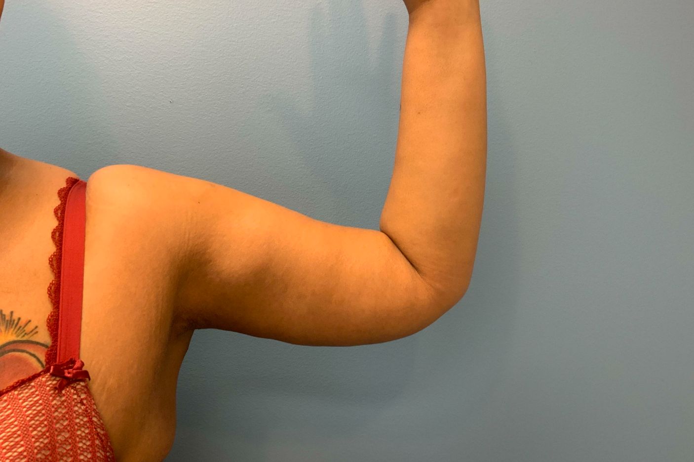 after surgery after weight loss left arm view female patient case 5488